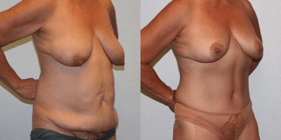 Breast Lift - Thumbnail 2