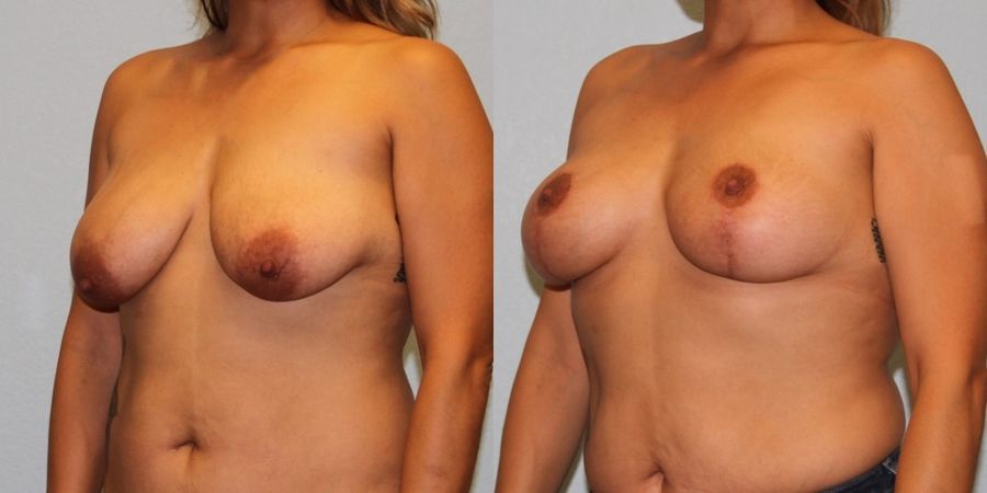 Breast Lift - Thumbnail 2