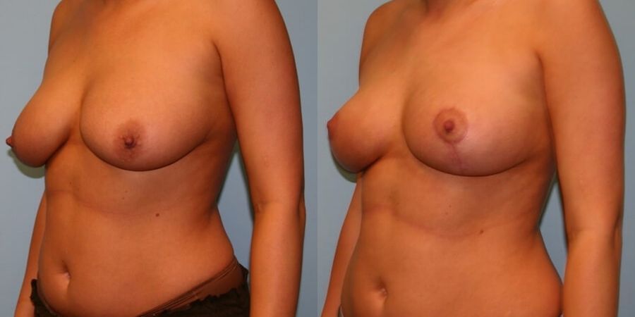Breast Lift - Thumbnail 3