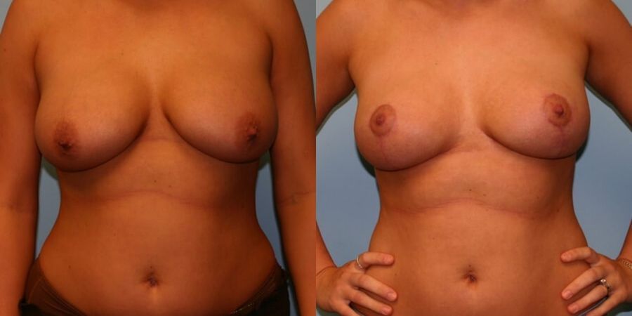 Breast Lift - Case 19402