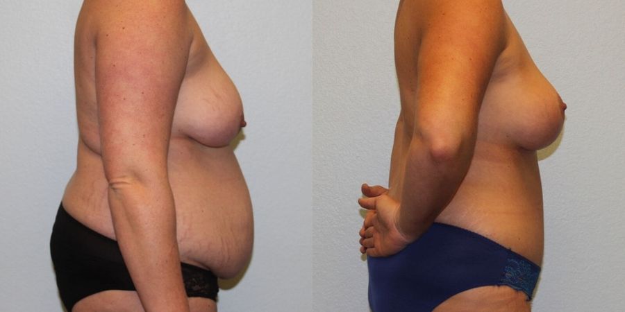 Breast Lift - Thumbnail 3