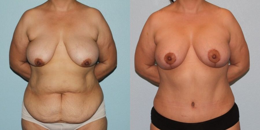 Breast Lift - Case 19393