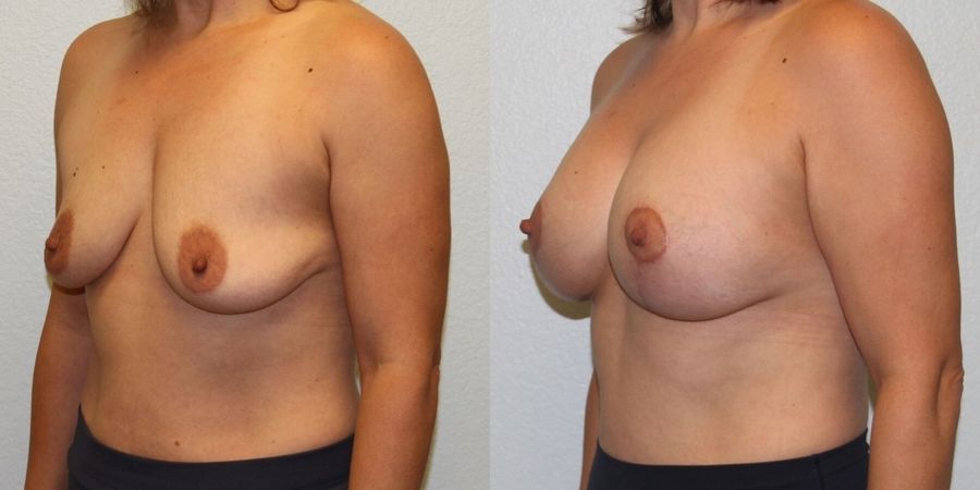 Breast Lift - Thumbnail 2