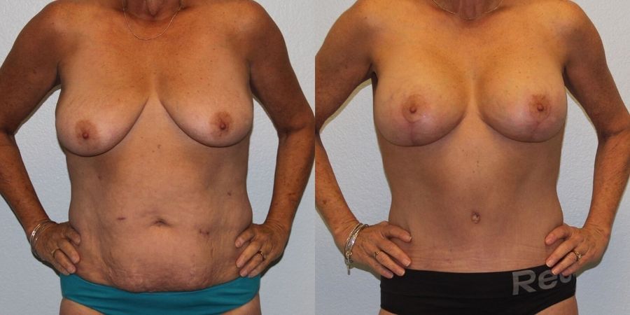 Breast Lift - Case 19395