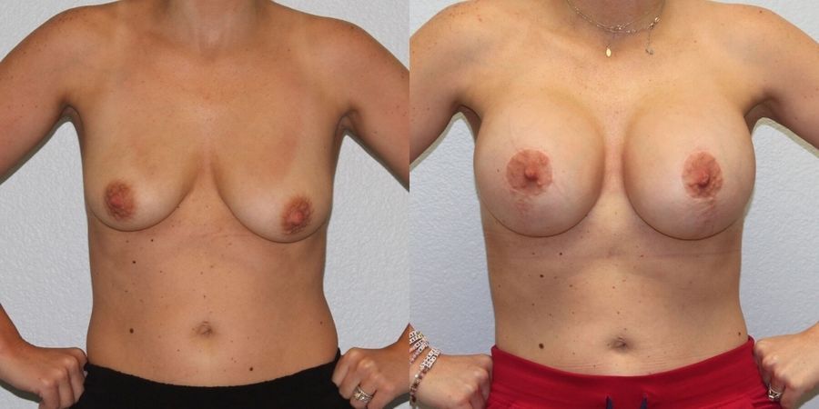 Breast Lift - Case 19391