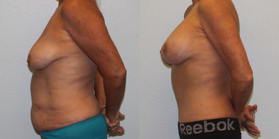 Breast Lift - Thumbnail 3