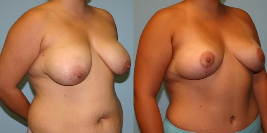 Breast Lift - Thumbnail 2