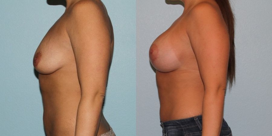 Breast Lift - Thumbnail 3