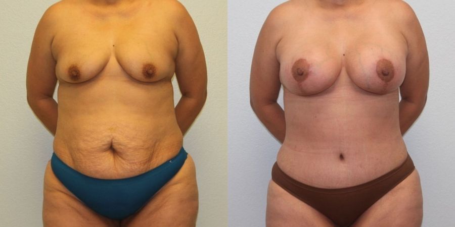 Breast Lift - Case 19397