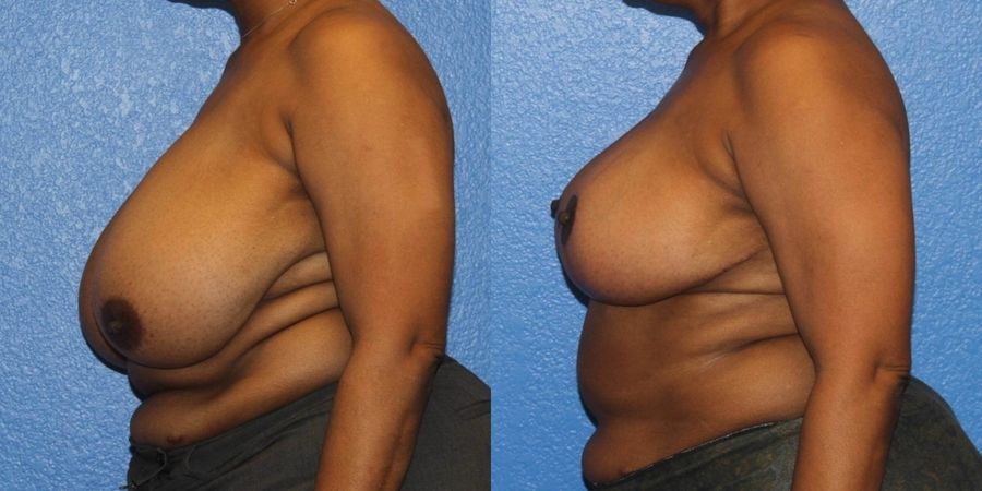 Breast Reduction - Thumbnail 3