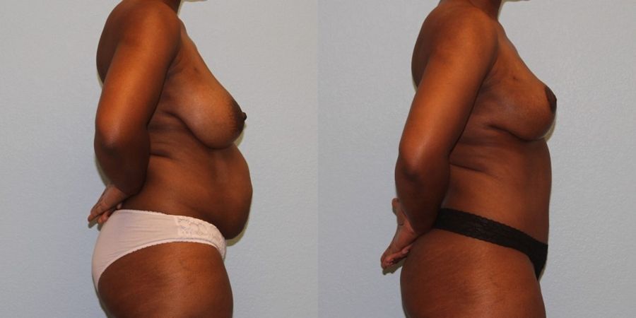 Breast Reduction - Thumbnail 3