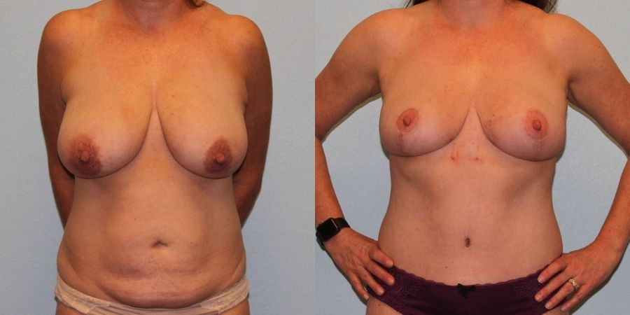 Breast Reduction - Case 19410