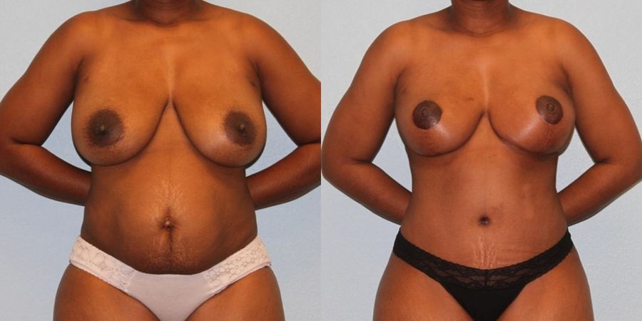 Breast Reduction - Case 19408