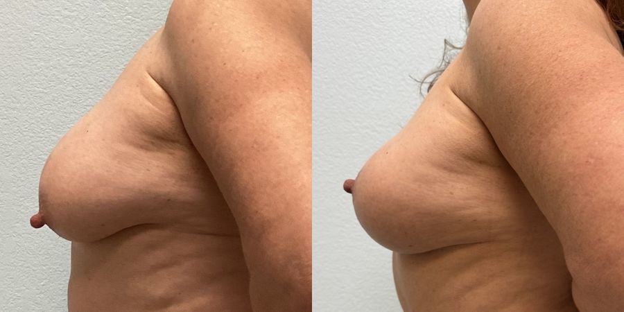 Breast Reduction - Thumbnail 3