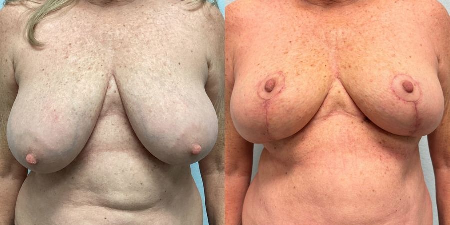 Breast Reduction - Case 19412
