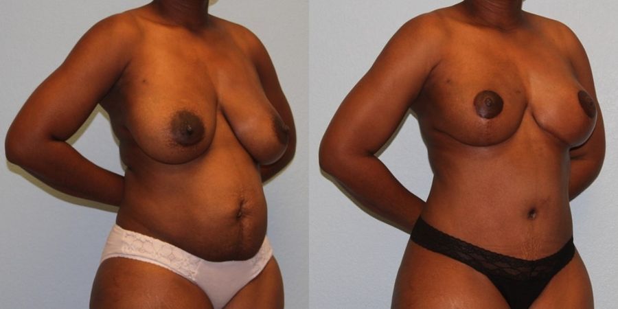 Breast Reduction - Thumbnail 2