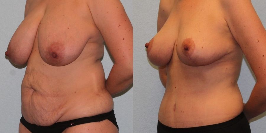 Breast Reduction - Thumbnail 2