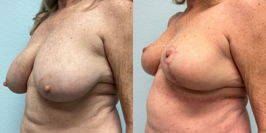 Breast Reduction - Thumbnail 2