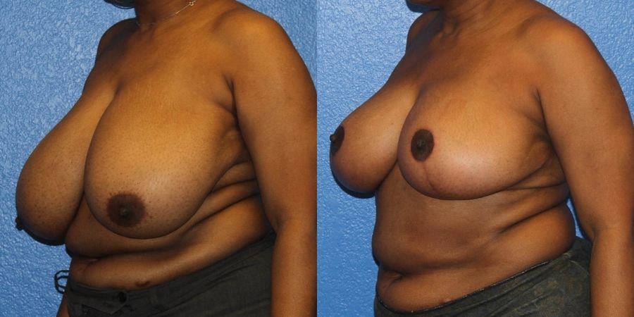 Breast Reduction - Thumbnail 2