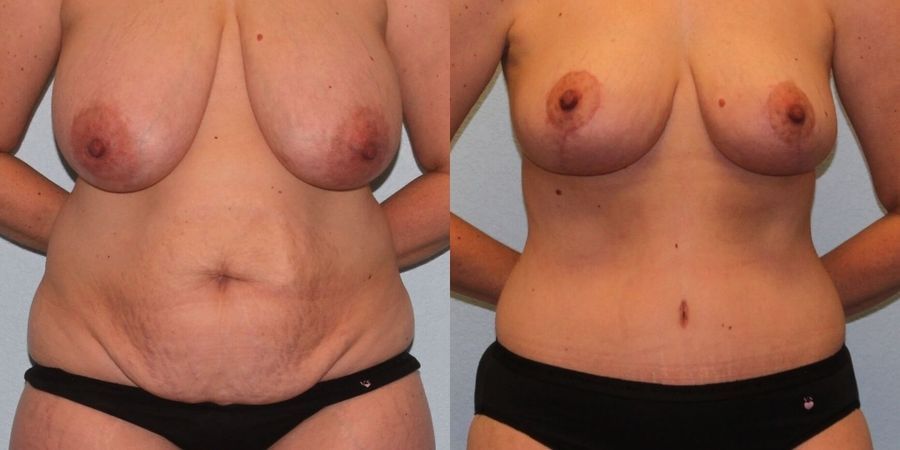 Breast Reduction - Case 19409