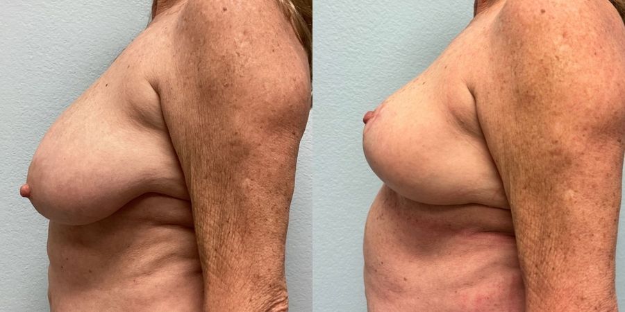 Breast Reduction - Thumbnail 3