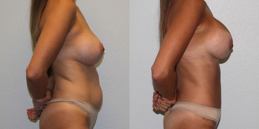 Breast Revision - Thumbnail 3