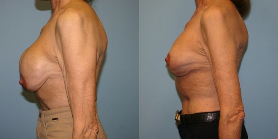 Breast Revision - Thumbnail 3