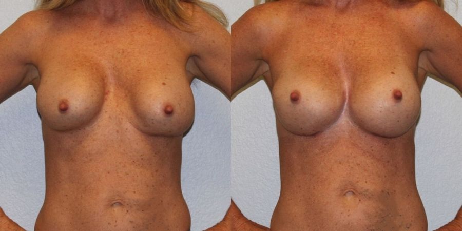Breast Revision - Case 19418