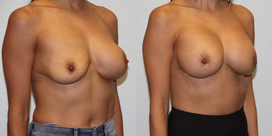 Breast Revision - Thumbnail 2