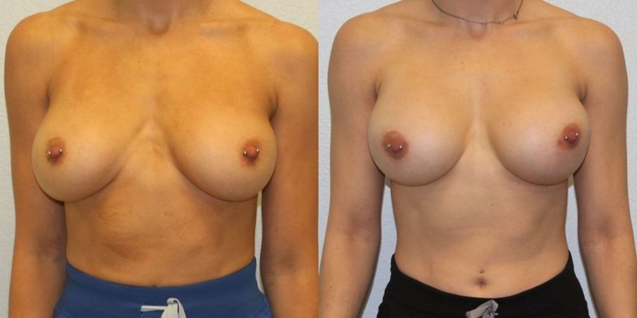 Breast Revision - Case 19413