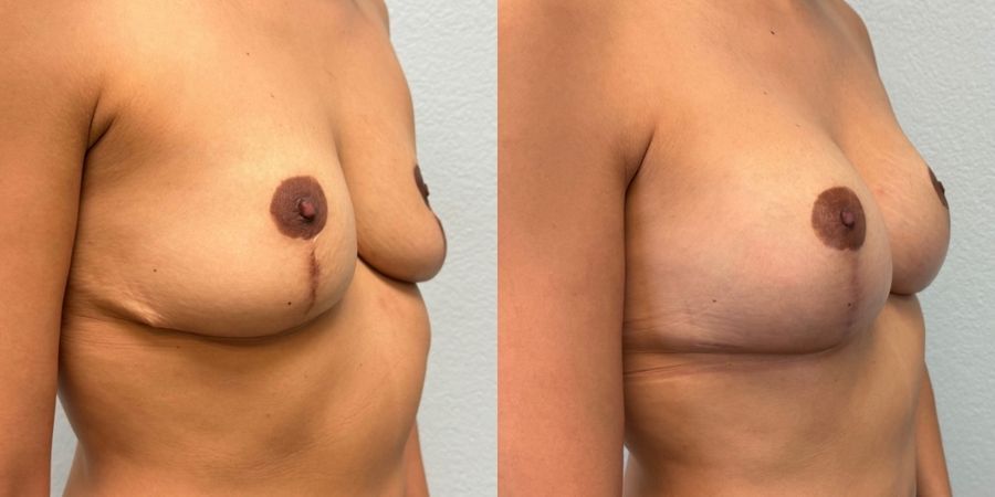 Breast Revision - Thumbnail 2