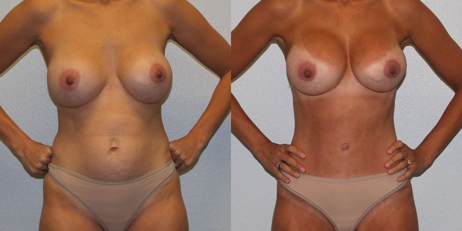 Breast Revision - Case 19417