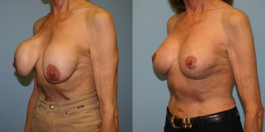 Breast Revision - Thumbnail 2