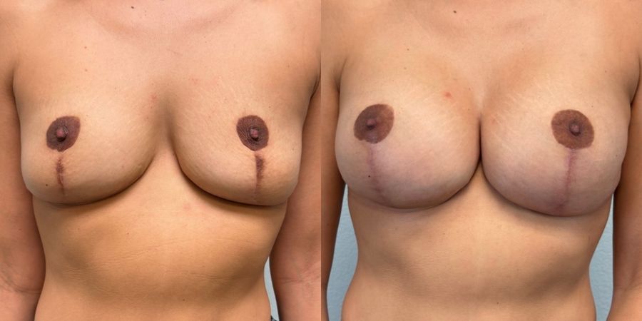 Breast Revision - Case 19425