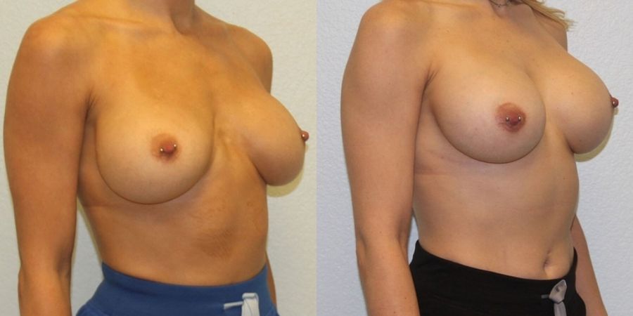 Breast Revision - Thumbnail 2
