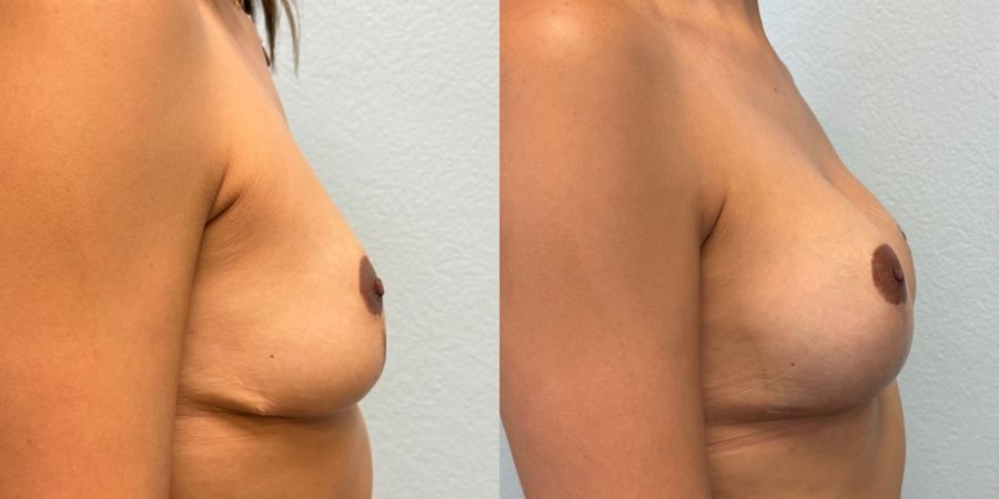 Breast Revision - Thumbnail 3