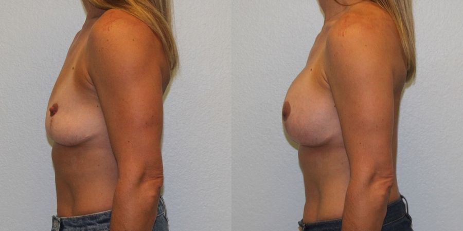 Breast Revision - Thumbnail 3