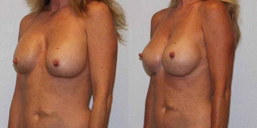 Breast Revision - Thumbnail 2