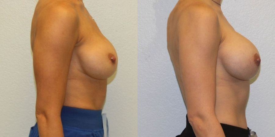 Breast Revision - Thumbnail 3