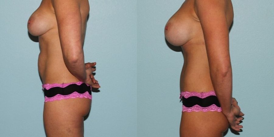 Breast Revision - Thumbnail 3