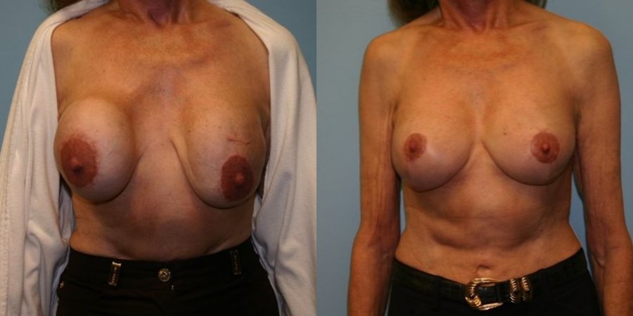Breast Revision - Case 19421
