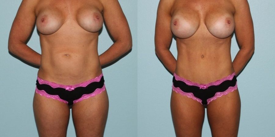 Breast Revision - Case 19423