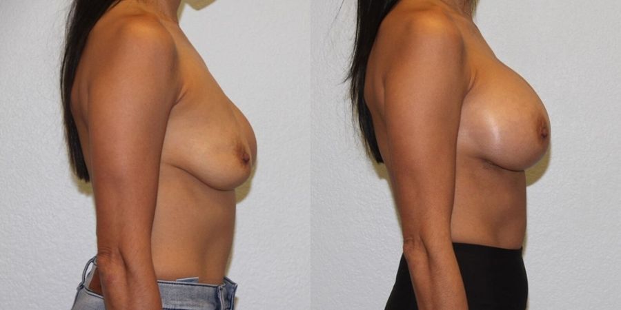 Breast Revision - Thumbnail 3