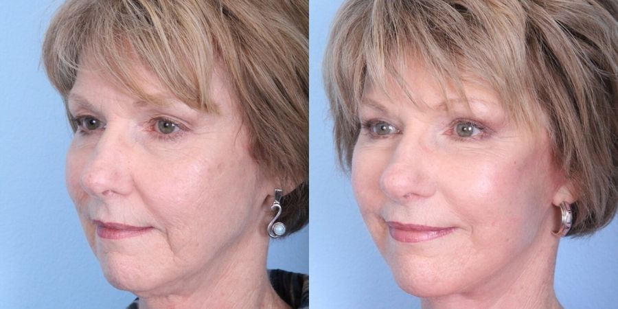 Eyelid Surgery - Thumbnail 2