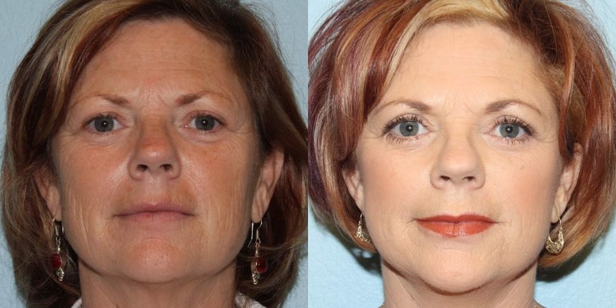 Eyelid Surgery - Case 19427