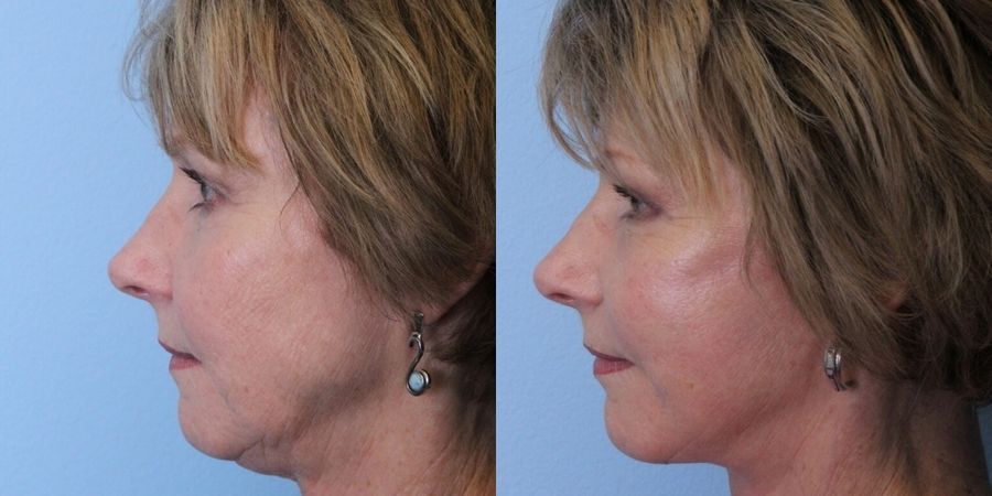 Eyelid Surgery - Thumbnail 3