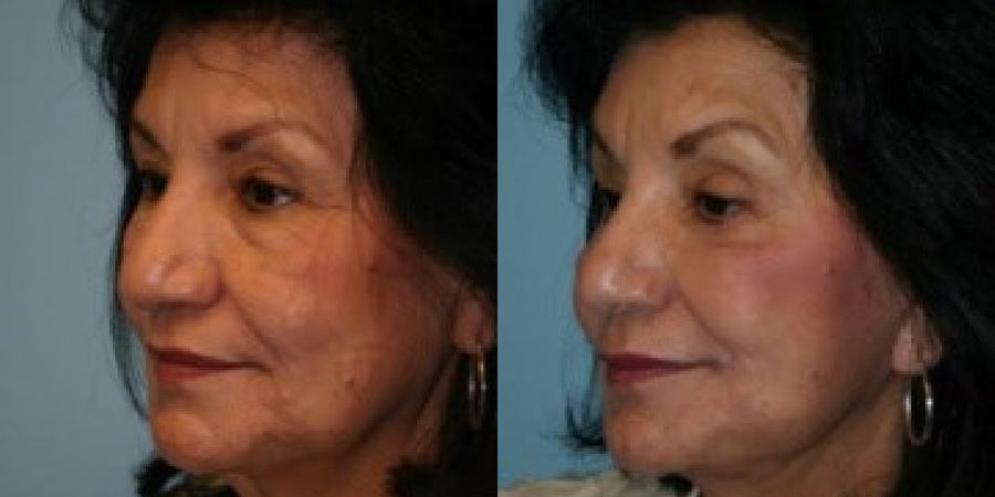 Facelift - Thumbnail 2