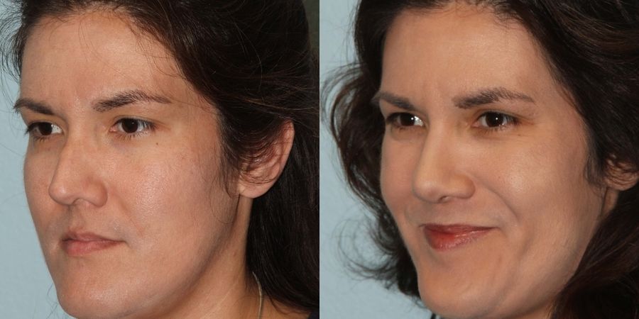 Facelift - Thumbnail 2