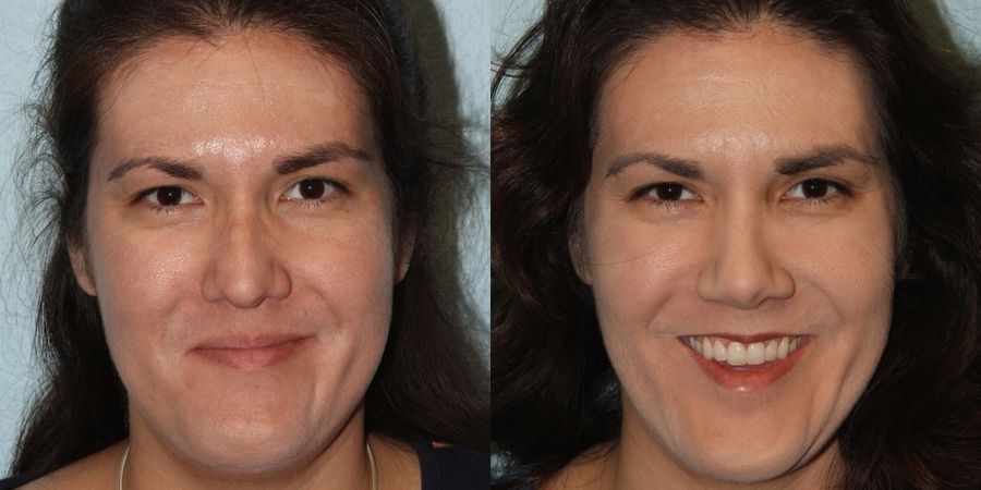 Facelift - Case 19429