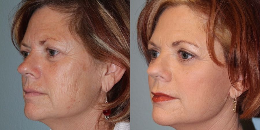 Facelift - Thumbnail 2